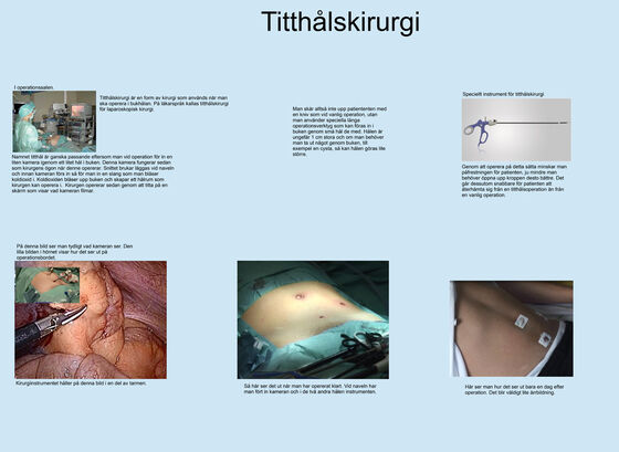 Titthålskirurgi - Poster (pdf 240 kB, ny flik).